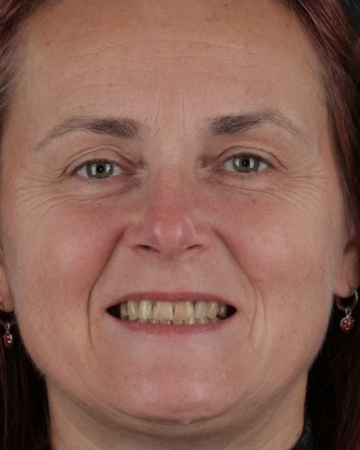 Transformare zâmbet, înainte, Clinica NEO Baia Mare