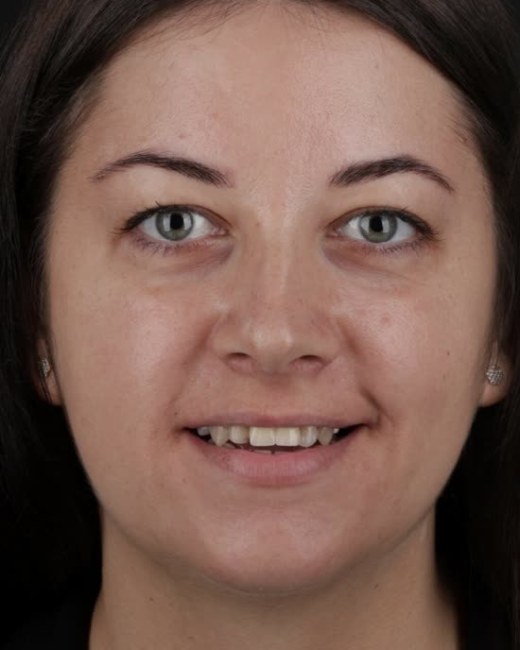 Transformare zâmbet, înainte, Clinica NEO Baia Mare