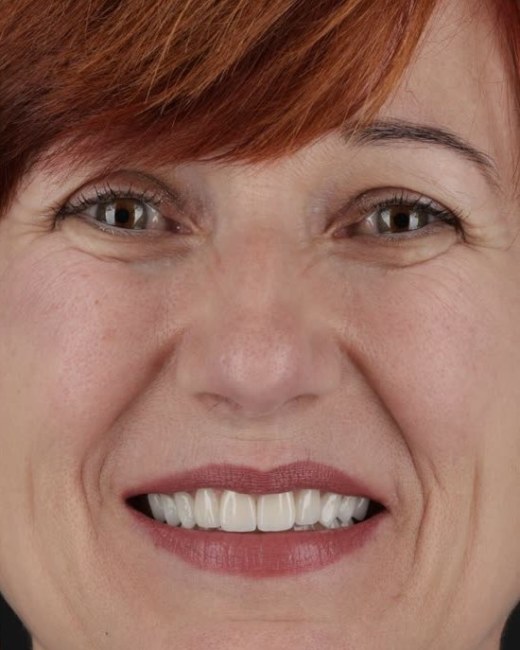 Transformare zâmbet, rezultat după, Clinica NEO Baia Mare
