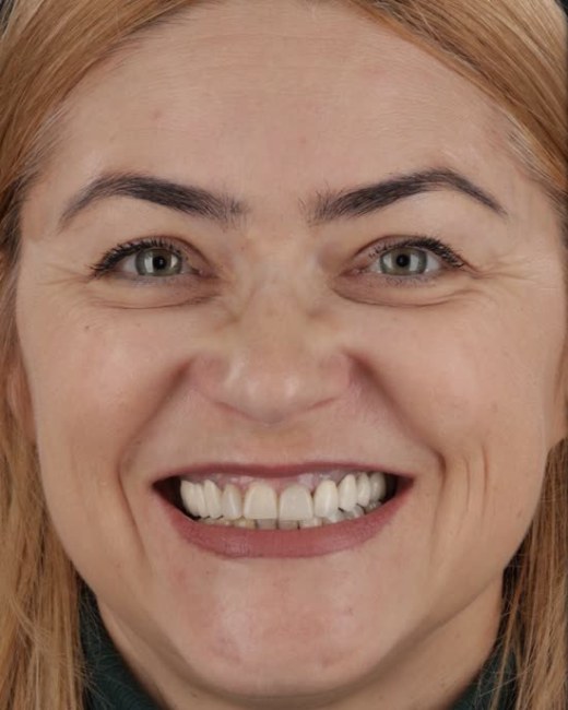 Transformare zâmbet, înainte, Clinica NEO Baia Mare