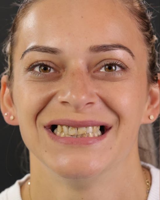 Transformare zâmbet, înainte, Clinica NEO Baia Mare